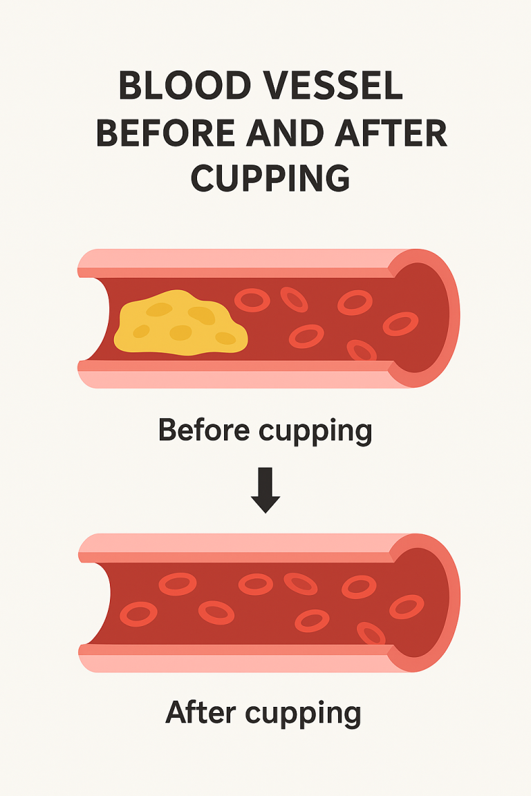 Illustration showing improved blood vessel flow and reduced cholesterol plaque after wet cupping.
