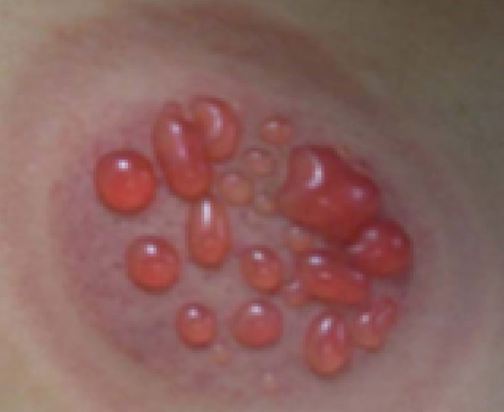 blister during cupping