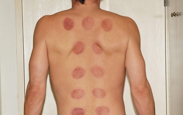 Cupping Marks