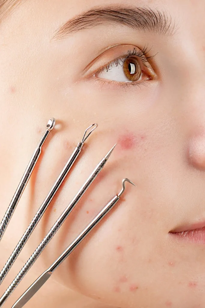 wet cupping for acne and skin health