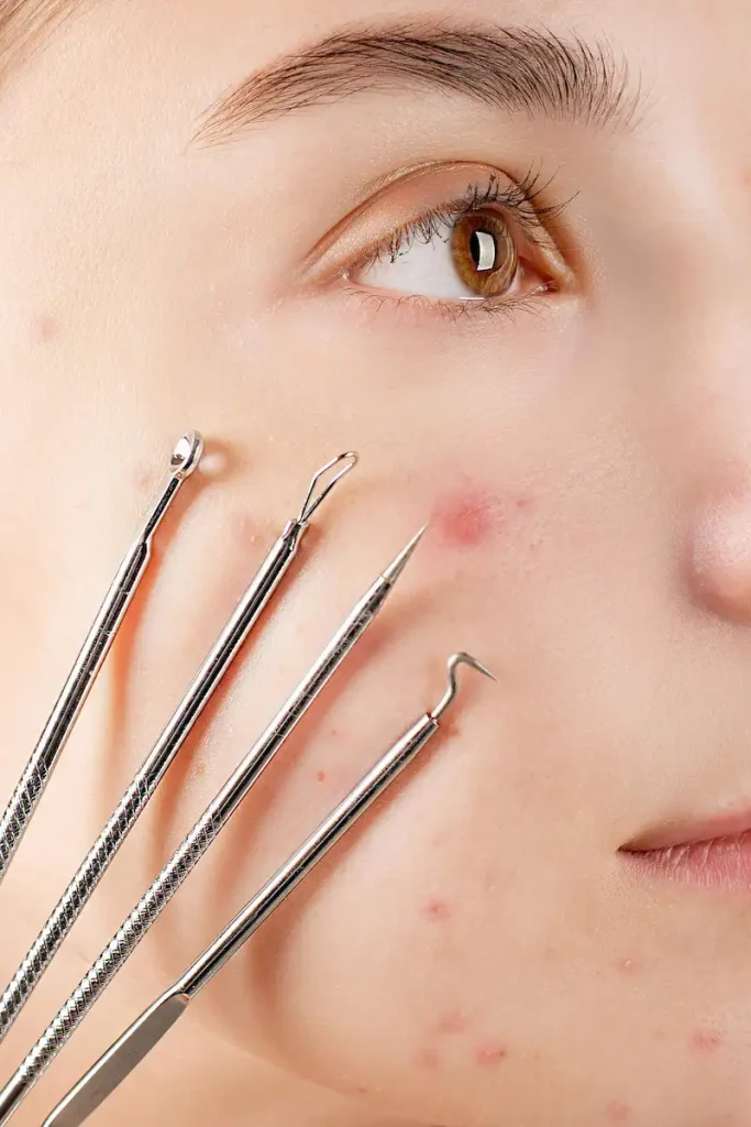 wet cupping, acne and skin health