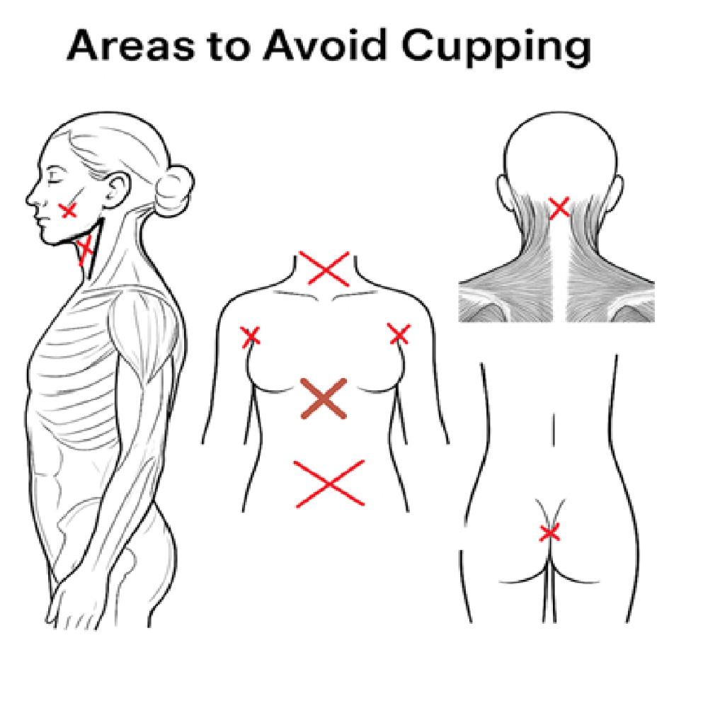 forbidden cupping area