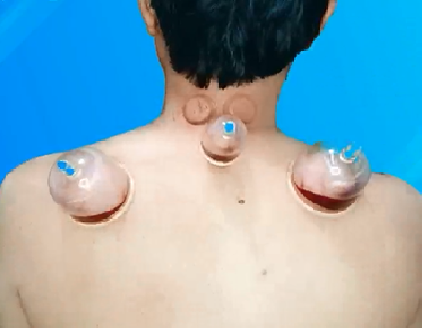 Wet cupping Vs Dry Cupping
