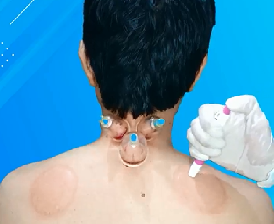 Wet cupping help balance nervous system