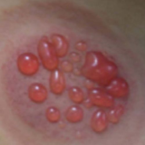 Blistering After Wet Cupping: Understanding and Managing Skin Reactions