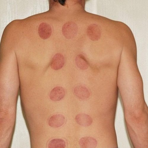 Cupping Marks Explained: What Those Red Circles Really Mean