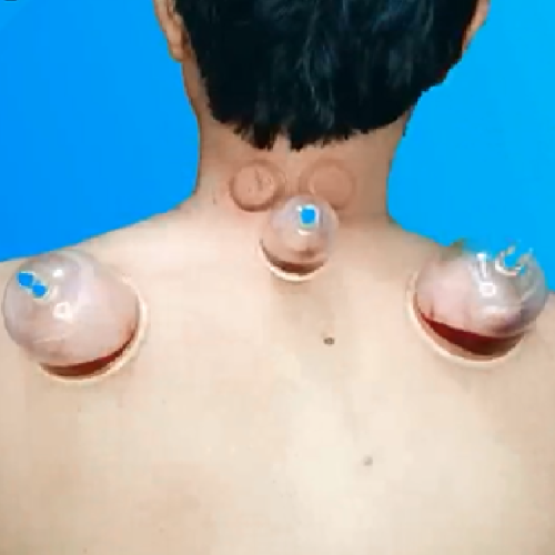 Dry vs Wet Cupping: What’s the Real Difference Inside Your Body?
