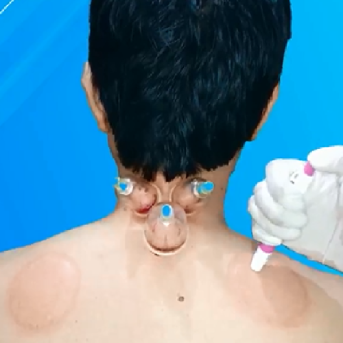 Wet Cupping for Beginners: What to Expect in Your First Session